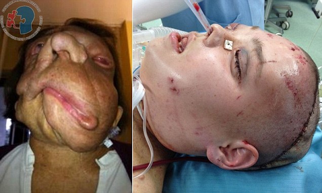 Wajah Rusak akibat Tumor Diperbaiki melalui Transplantasi